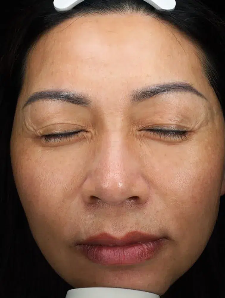 Melasma After Treatment · Case 21 · Luowei Medical Aesthetics Clinic
