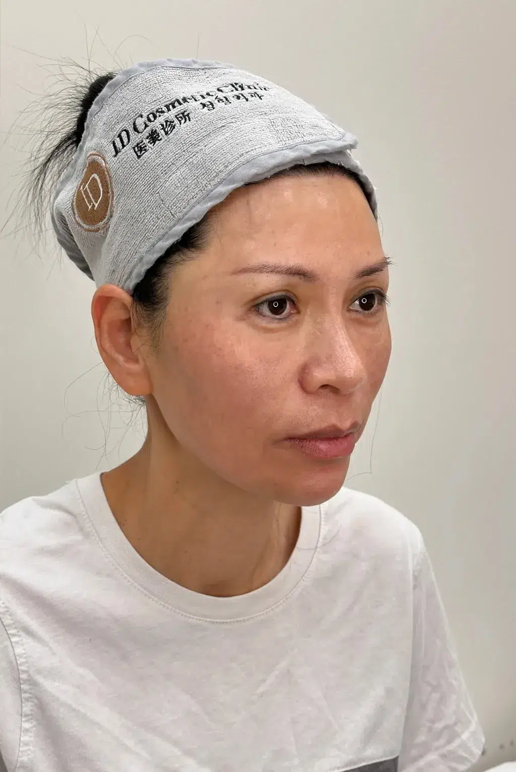 Melasma After Treatment · Case 22 · Luowei