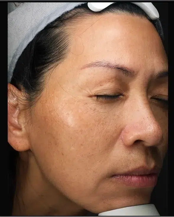 Melasma Before Treatment · Case 09 · Luowei Medical Aesthetics Clinic
