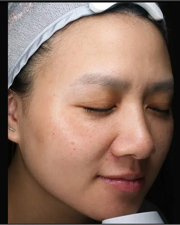 Melasma Before Treatment · Case 13 · Luowei Medical Aesthetics Clinic