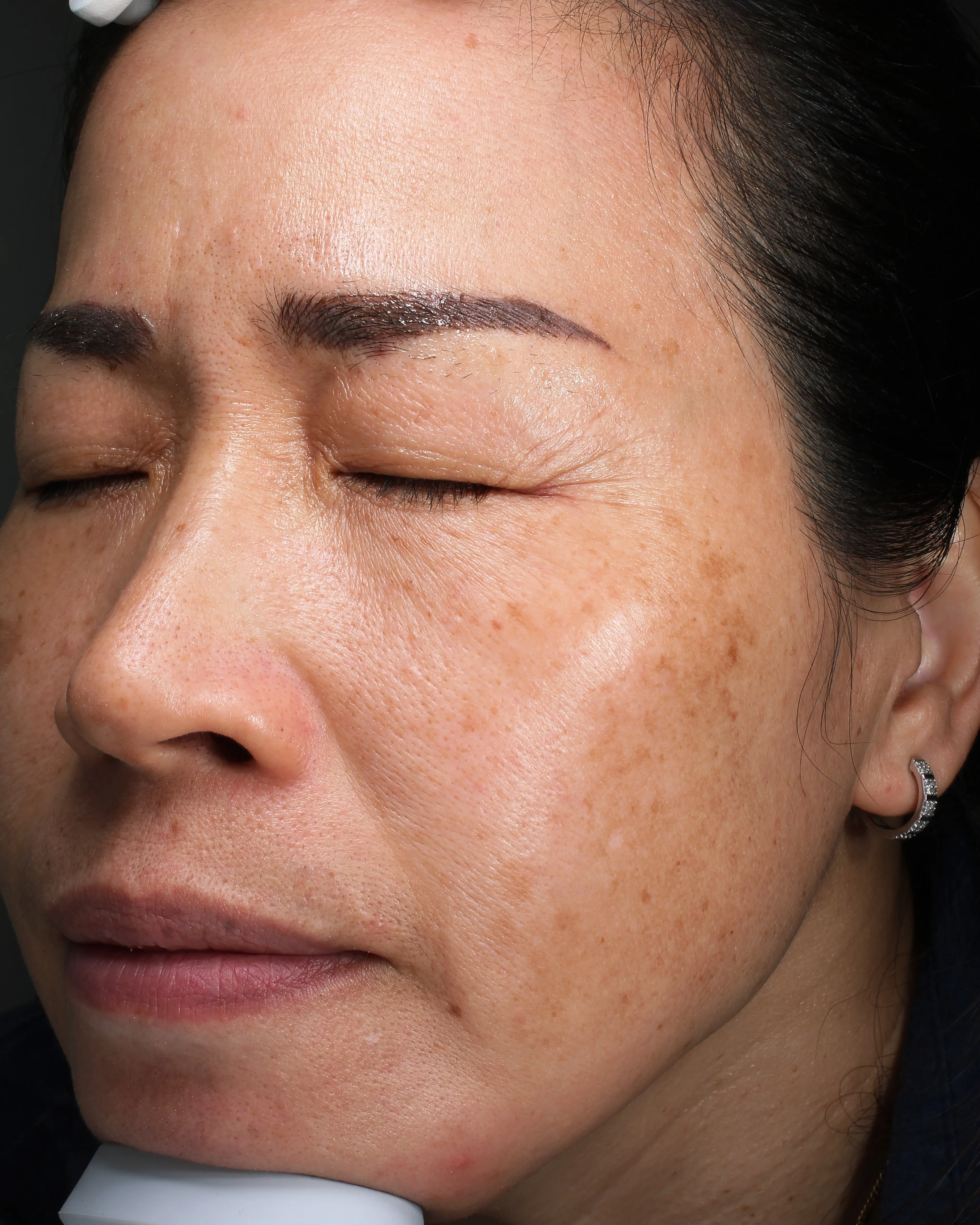 Melasma Before Treatment · Case 17 · Luowei Medical Aesthetics Clinic