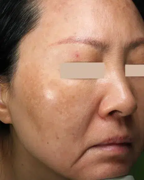 Melasma Before Treatment · Case 18 · Luowei