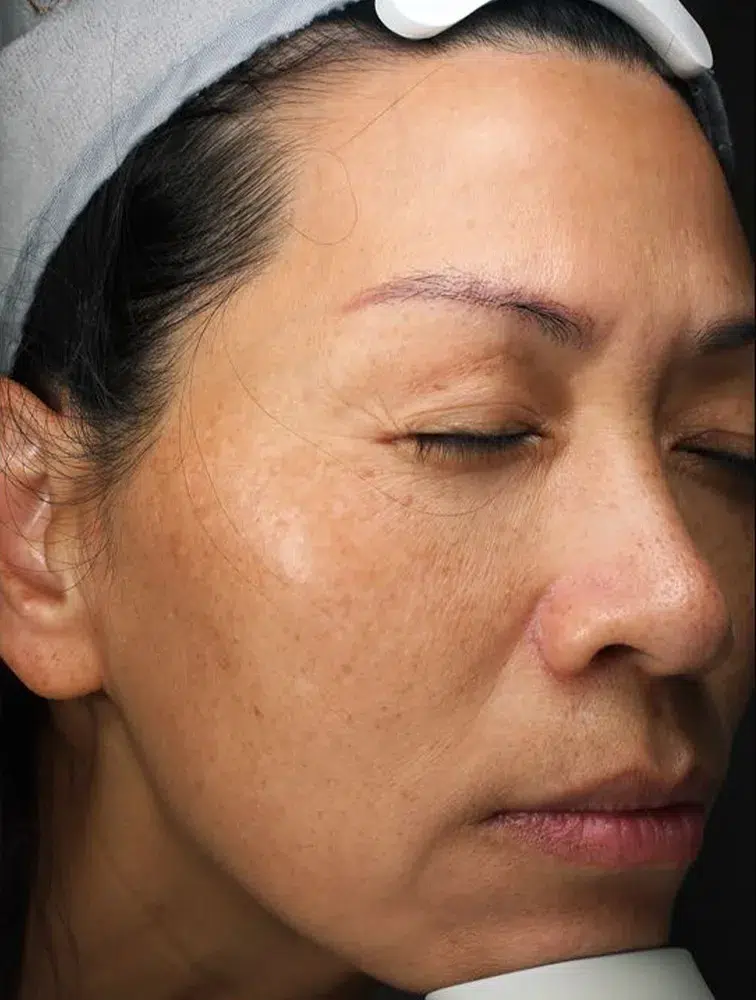 Melasma Before Treatment · Case 20 · Luowei Medical Aesthetics Clinic