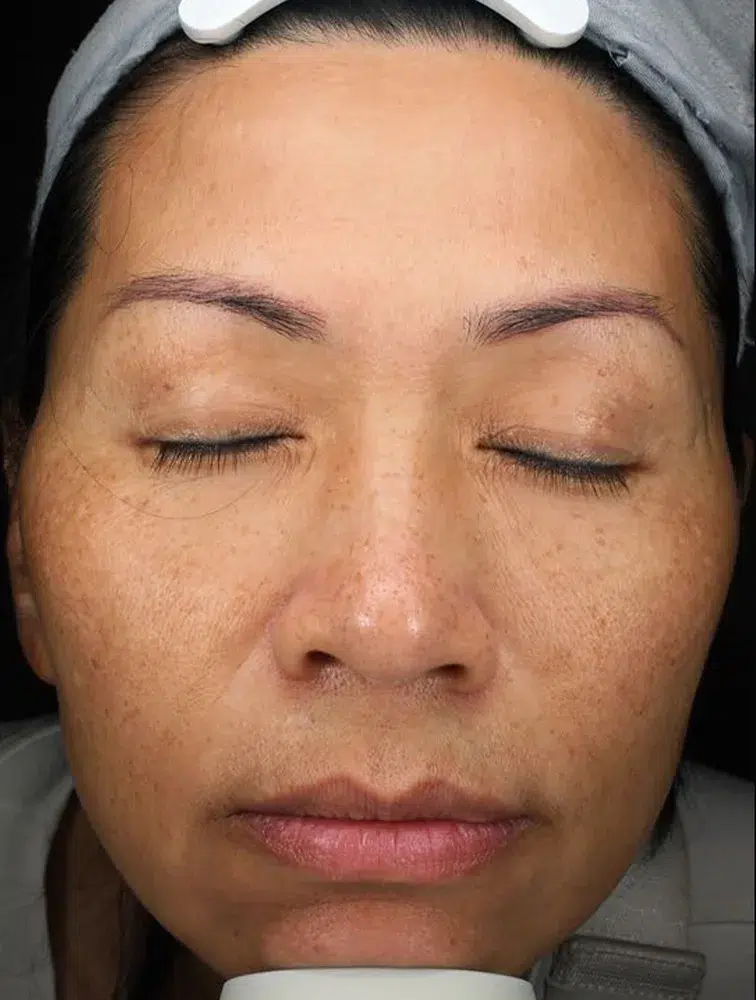 Melasma Before Treatment · Case 21 · Luowei Medical Aesthetics Clinic