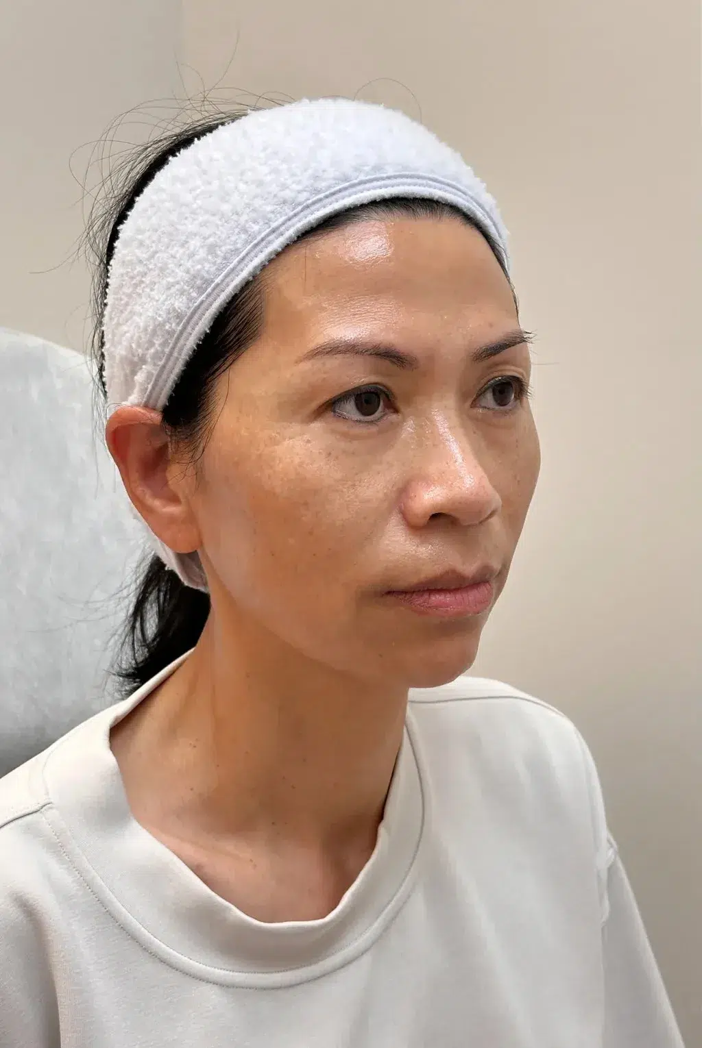Melasma Before Treatment · Case 22 · Luowei Medical Aesthetics Clinic