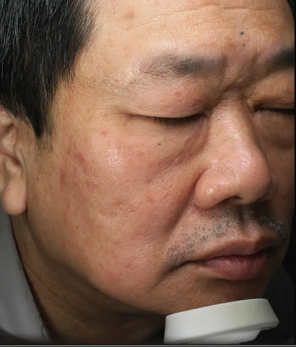 Post-Inflammatory Hyperpigmentation — After Treatment · Case 01 · Luowei Medical Aesthetics Clinic