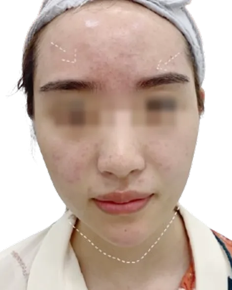 Receding chin After · Case 1 · Luowei Medical Aesthetics Clinic