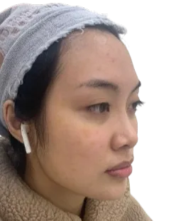 Receding chin — After · Case 10 · Luowei