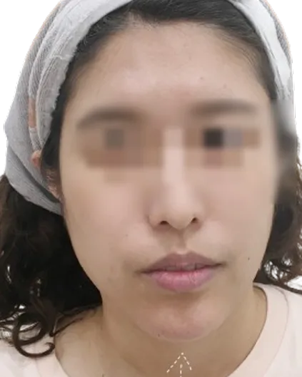 Chin Retrusion — After · Case 14 · Luowei Medical Aesthetics Clinic