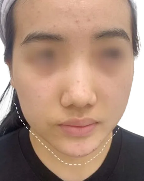 Receding Chin, After · Case 17 · Luowei Medical Aesthetics Clinic