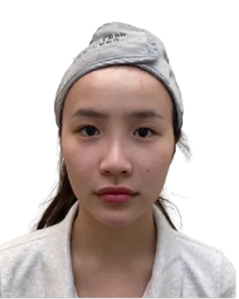 Retruded chin · after · Case 21 · Luowei Medical Aesthetics Clinic