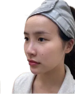 Receding chin After · Case 22 · Luowei Medical Aesthetics Clinic