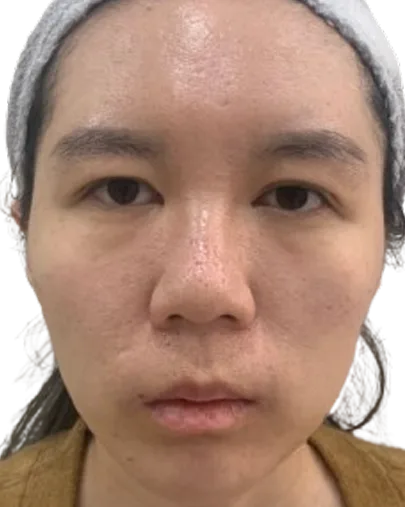 Receding chin — After · Case 23 · Luowei