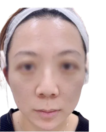 Chin Retrusion — After · Case 28 · Luowei Medical Aesthetics Clinic