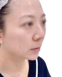 Receding Chin, After · Case 32 · Luowei Medical Aesthetics Clinic