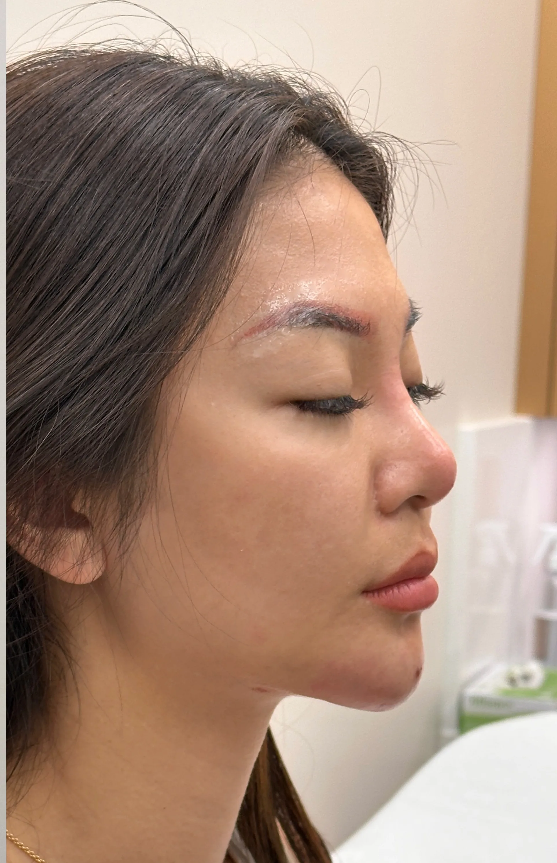 Retruded chin · after · Case 44 · Luowei Medical Aesthetics Clinic