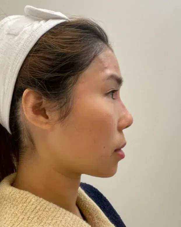 Receding chin After · Case 49 · Luowei Medical Aesthetics Clinic