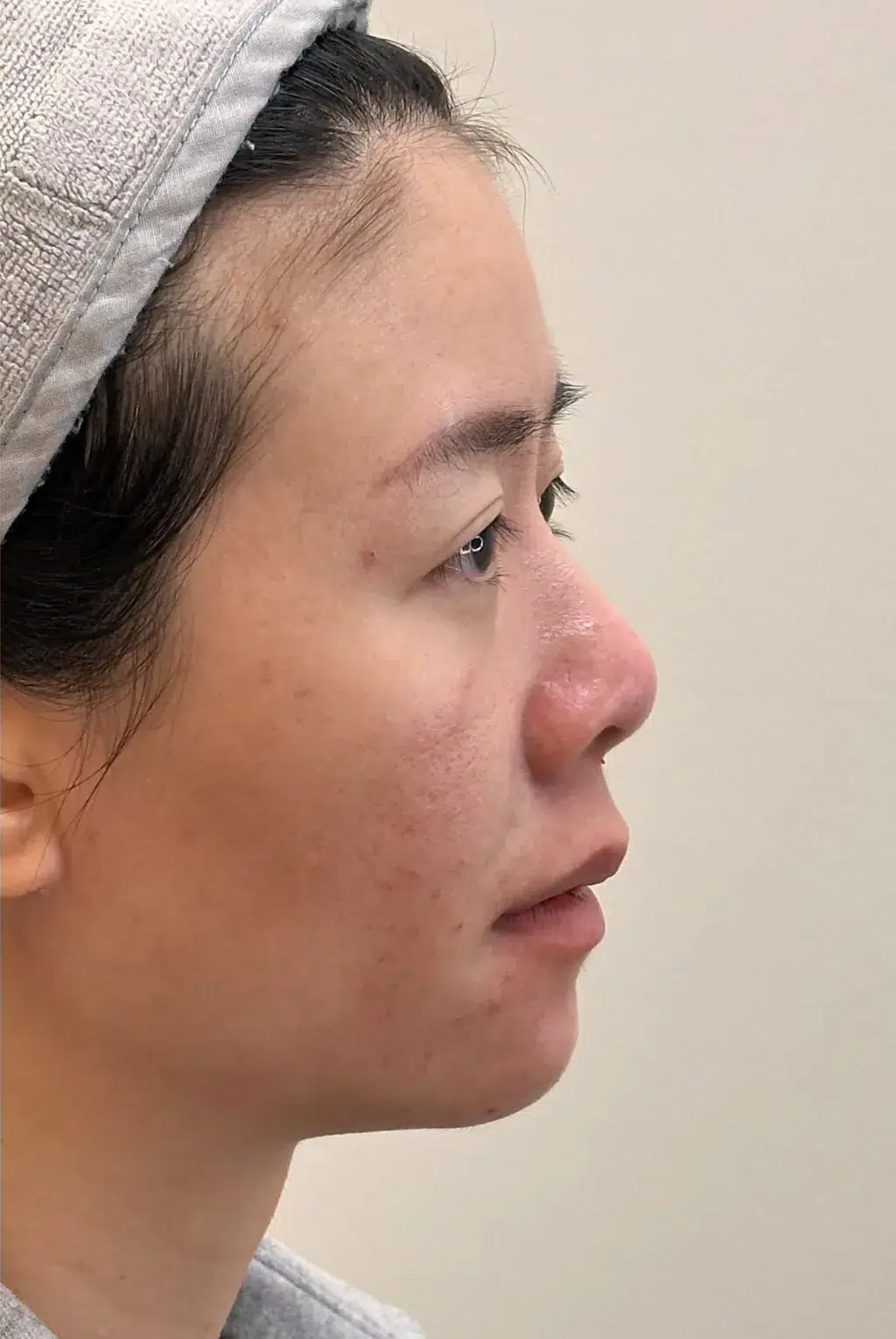Receding Chin After Treatment · Case 26 · Luowei Medical Aesthetics Clinic