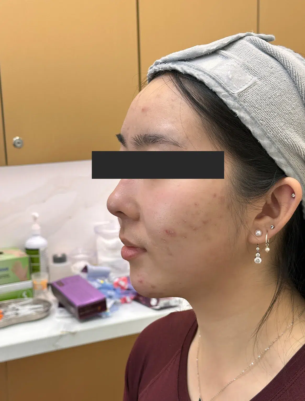 Chin Retrusion — After Treatment · Case 28 · Luowei Medical Aesthetics Clinic