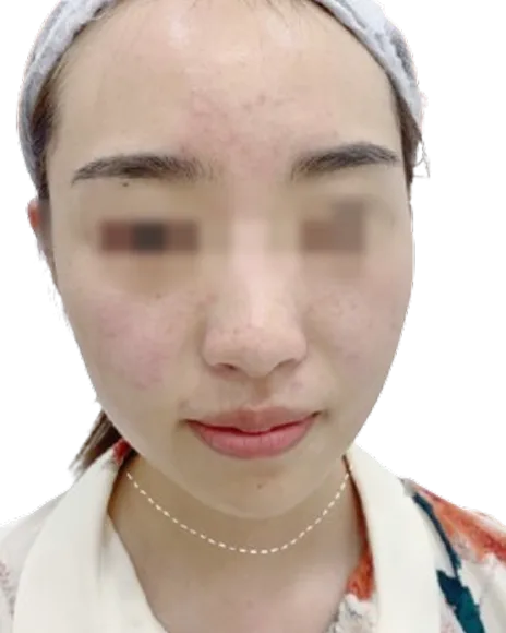 Retruded chin · before · Case 1 · Luowei Medical Aesthetics Clinic