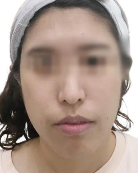 Receding chin — Before · Case 14 · Luowei