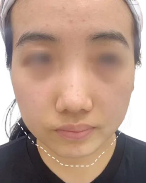 Chin Retrusion — Before · Case 17 · Luowei Medical Aesthetics Clinic