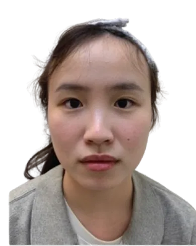 Receding Chin, Before · Case 21 · Luowei Medical Aesthetics Clinic