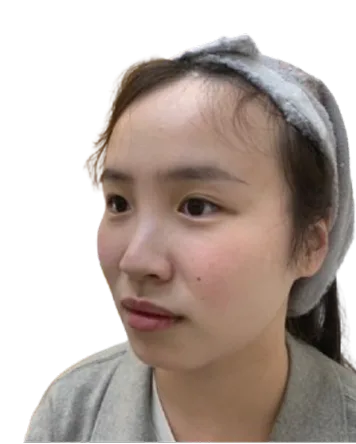 Retruded chin · before · Case 22 · Luowei Medical Aesthetics Clinic