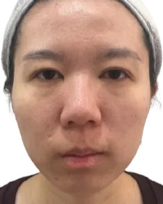 Receding chin Before · Case 23 · Luowei Medical Aesthetics Clinic