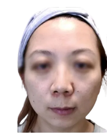 Receding chin — Before · Case 28 · Luowei