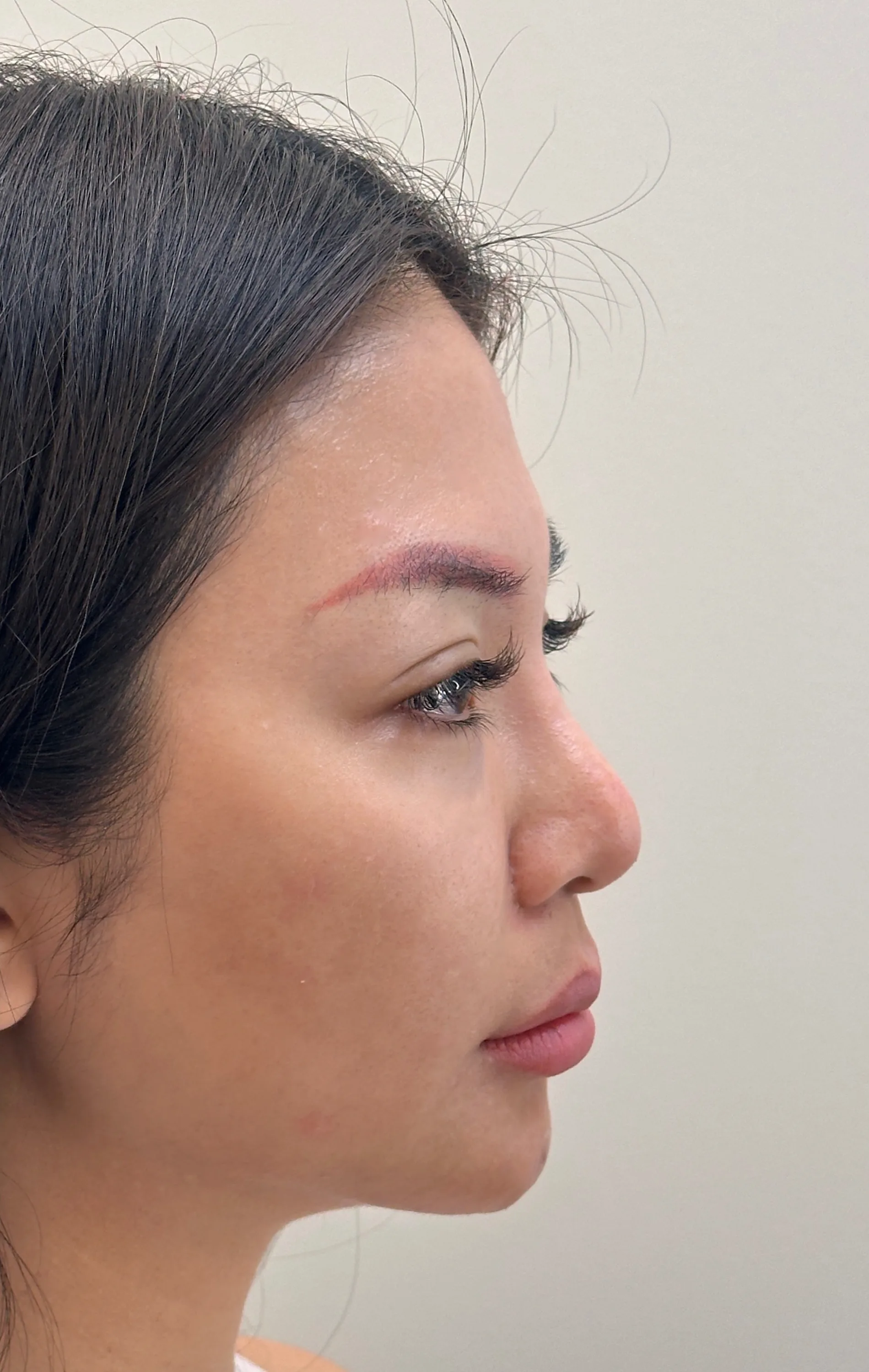 Receding Chin, Before · Case 44 · Luowei Medical Aesthetics Clinic