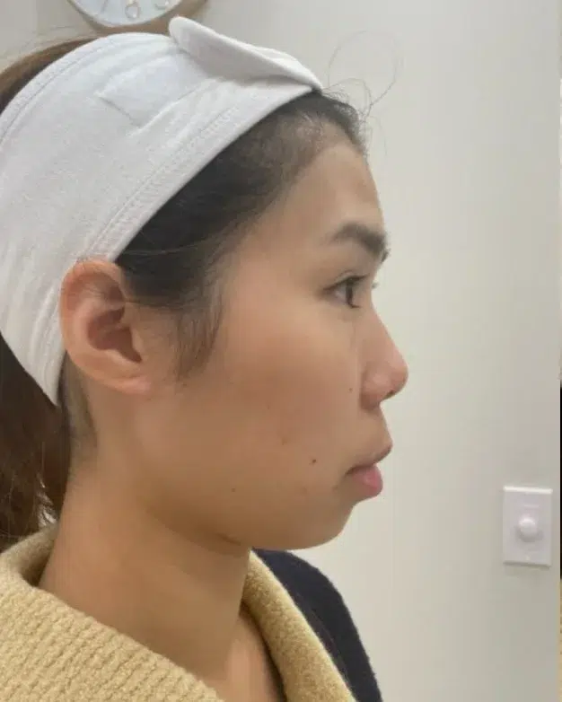 Retruded chin · before · Case 49 · Luowei Medical Aesthetics Clinic