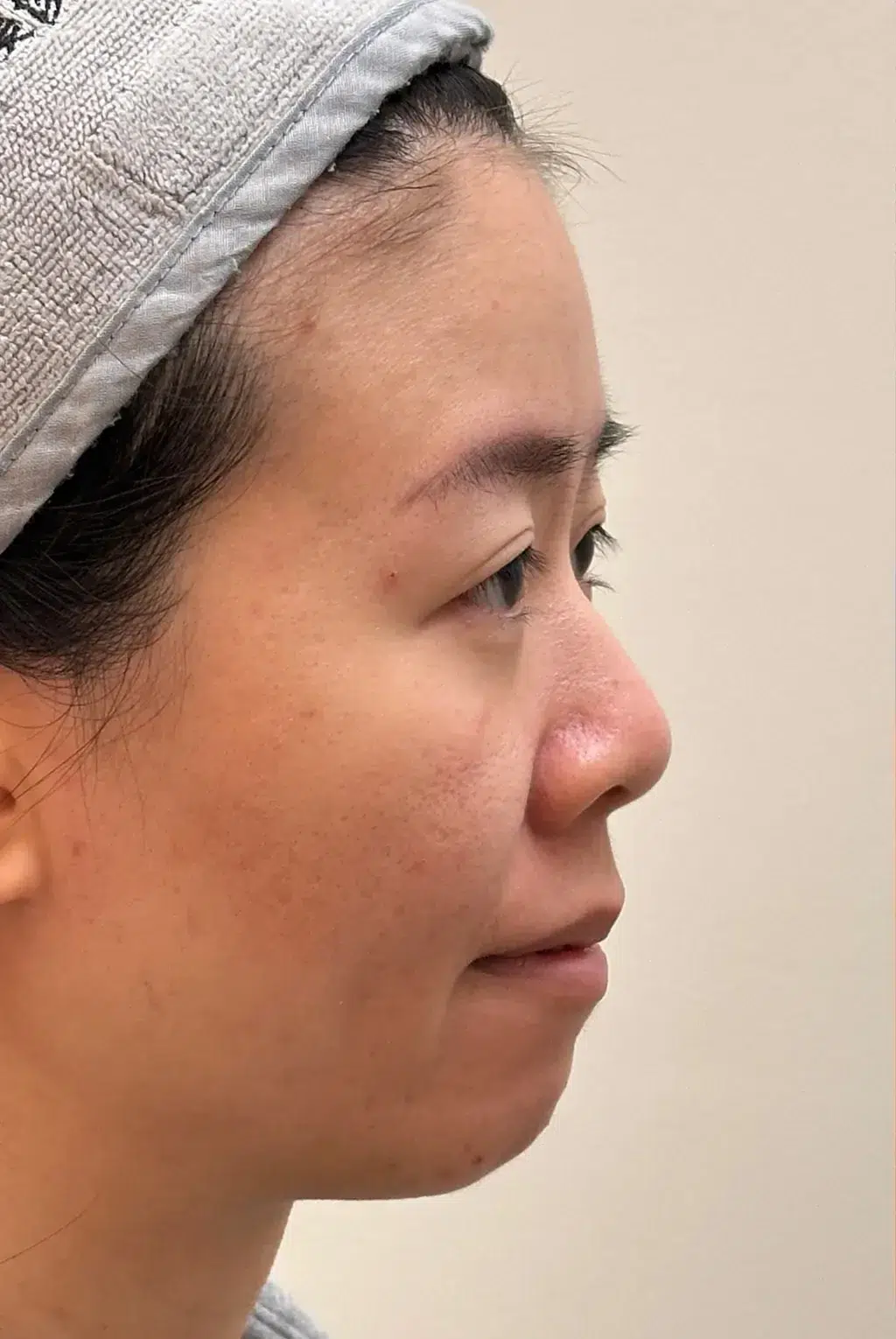 Receding Chin Before Treatment · Case 26 · Luowei Medical Aesthetics Clinic