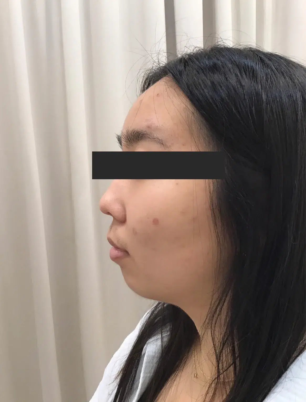 Chin Retrusion — Before Treatment · Case 28 · Luowei Medical Aesthetics Clinic
