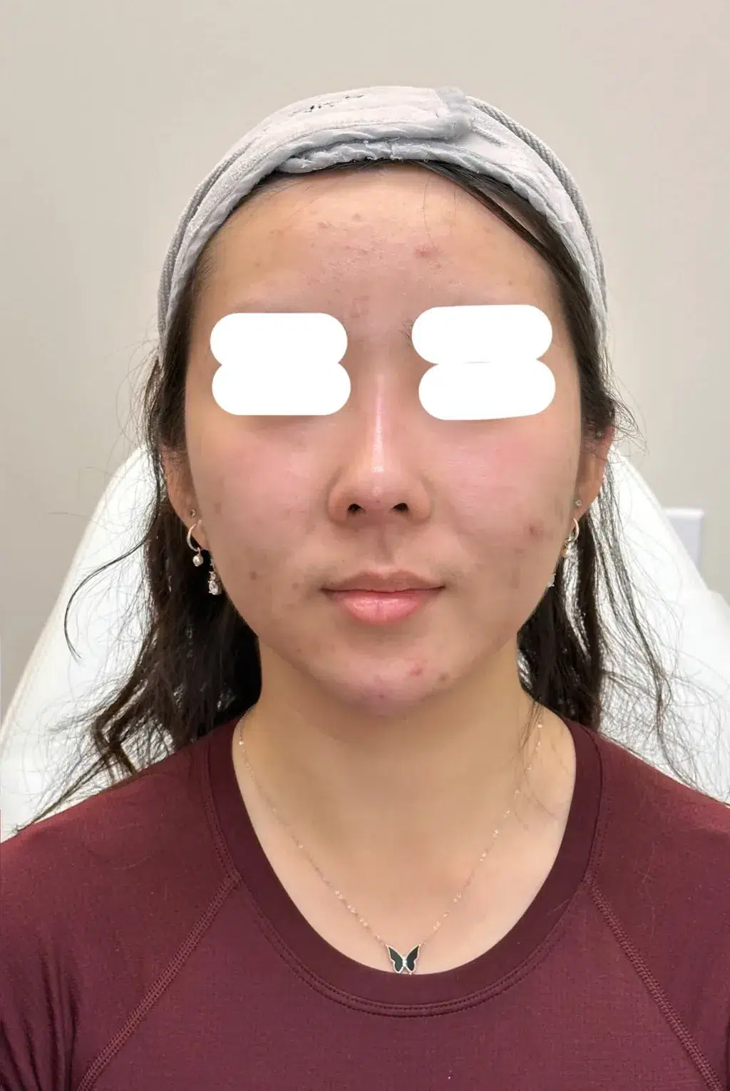 Refined Nose Profile — After · Case 01 · Luowei Medical Aesthetics Clinic