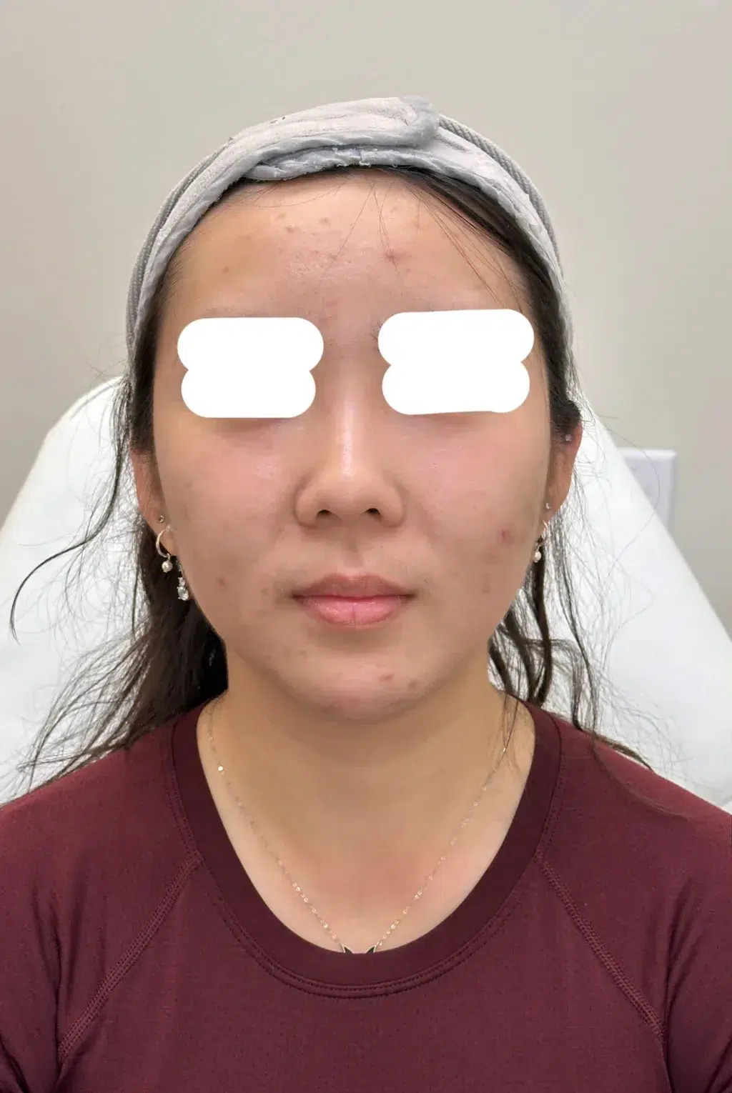 Delicate Nose · Before · Case 01 · Luowei Medical Aesthetics Clinic