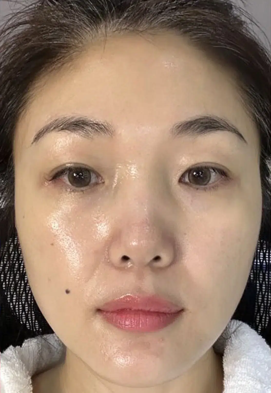 Skin Sagging — After Treatment · Case 1 · Luowei Medical Aesthetics Clinic