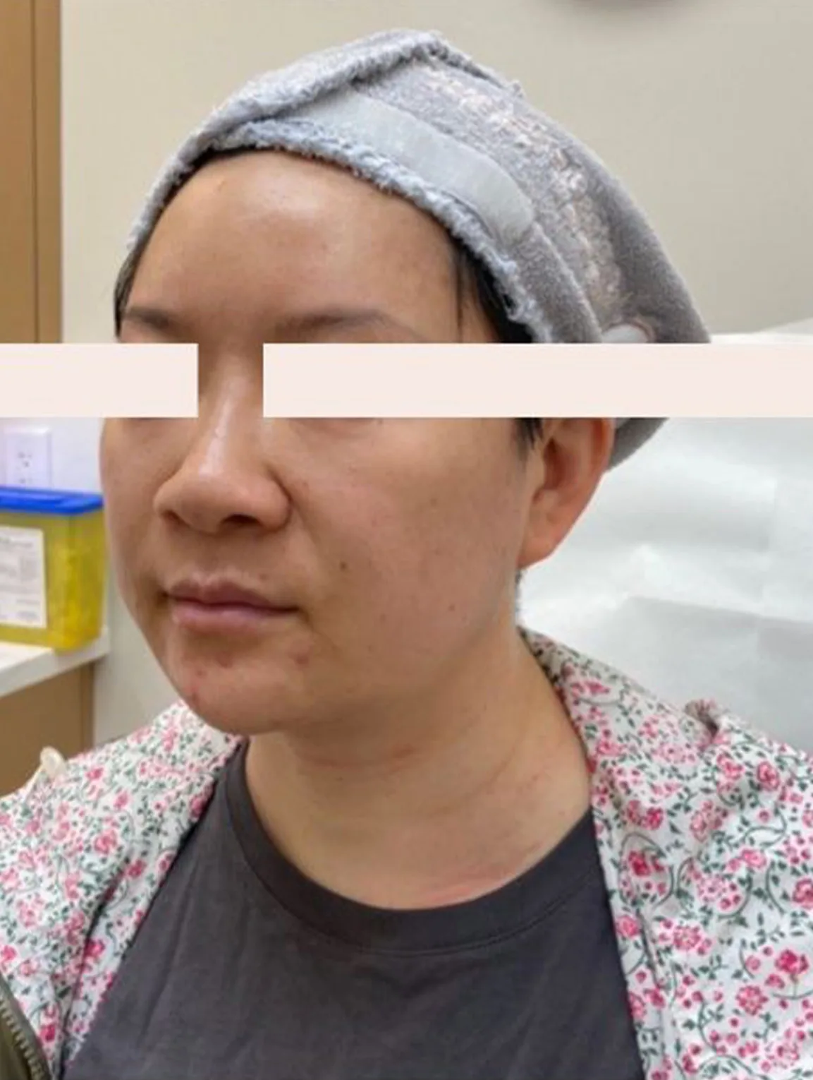 Skin Laxity — After Treatment · Case 3 · Luowei Medical Aesthetics Clinic