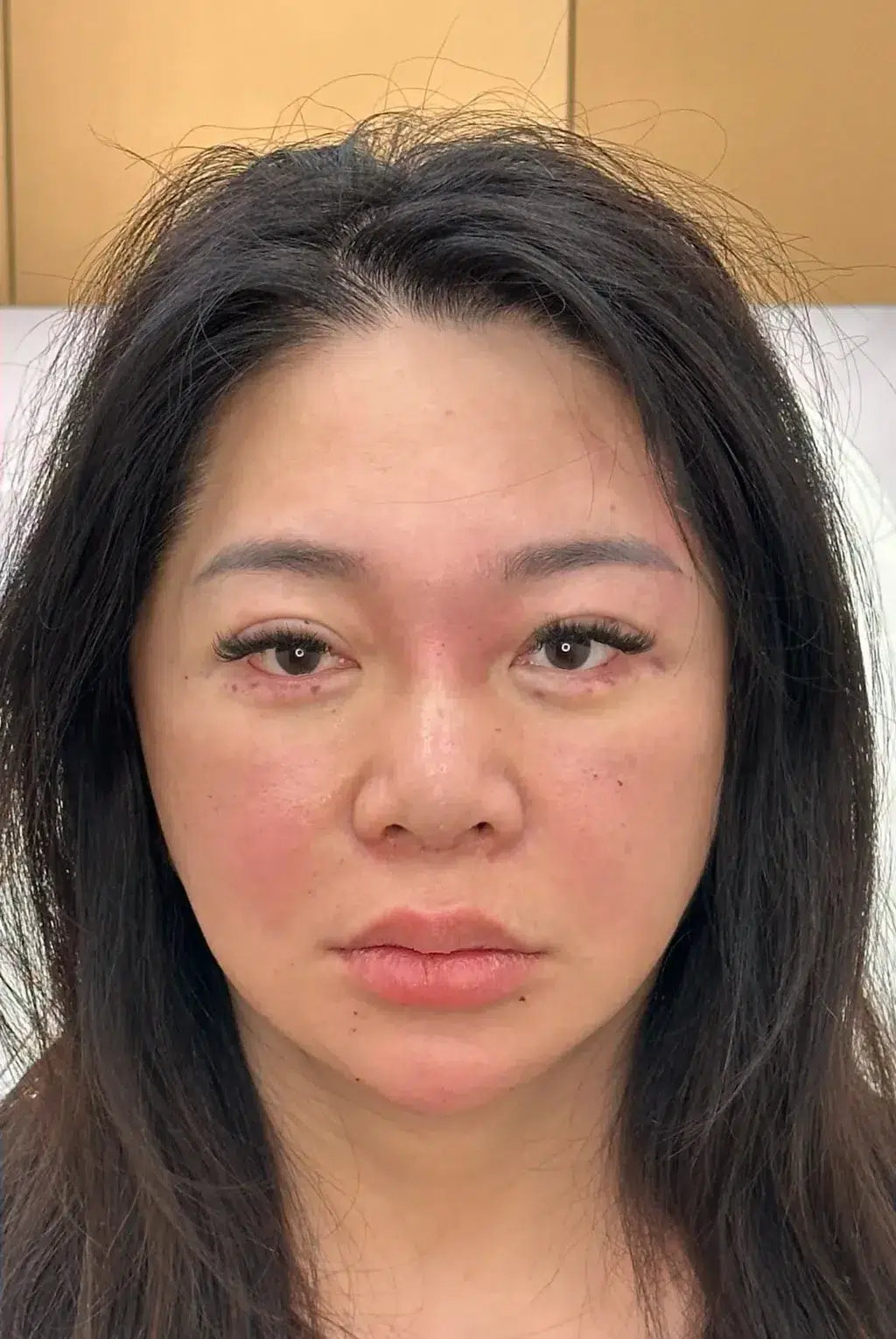 Skin laxity · after · Case 29 · Luowei Medical Aesthetics Clinic