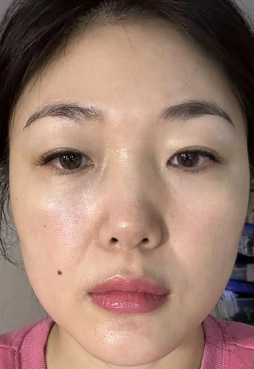 Skin Laxity — Before Treatment · Case 1 · Luowei Medical Aesthetics Clinic