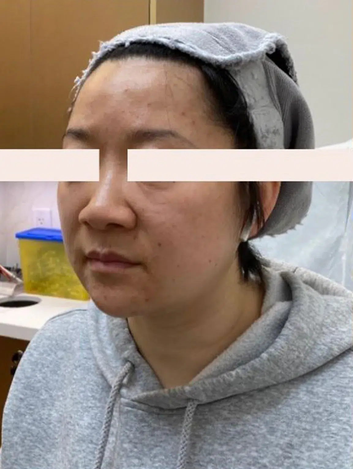 Skin Sagging — Before Treatment · Case 3 · Luowei Medical Aesthetics Clinic