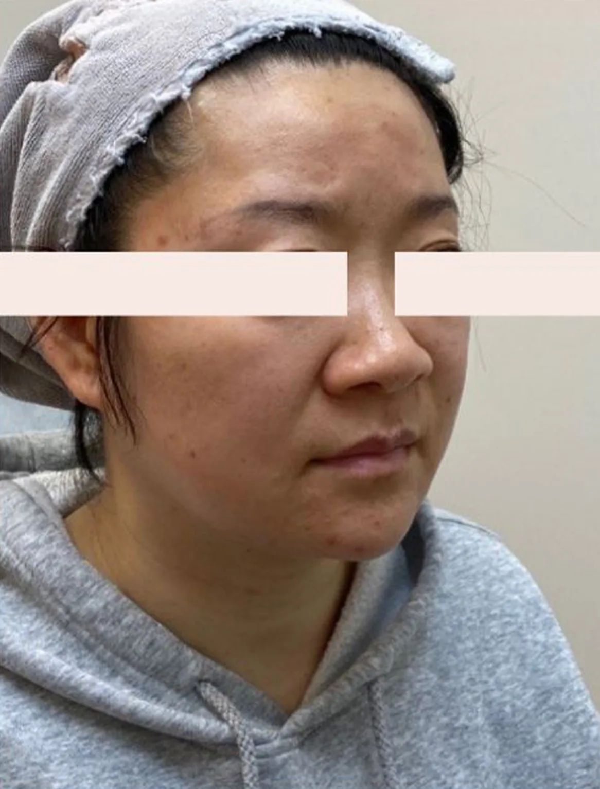 Skin Laxity — Before Treatment · Case 5 · Luowei Medical Aesthetics Clinic