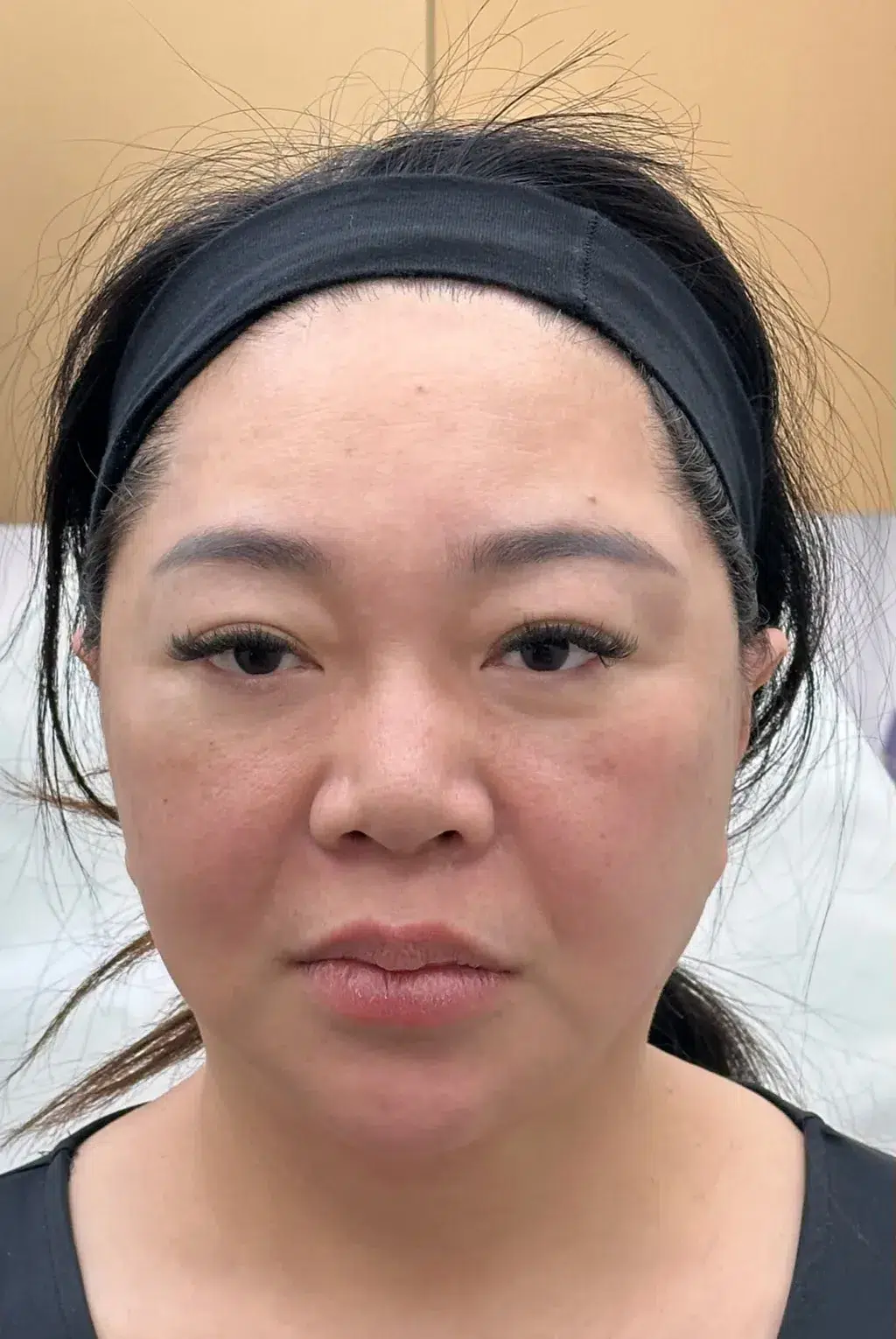 Skin Laxity — Before · Case 29 · Luowei Medical Aesthetics Clinic