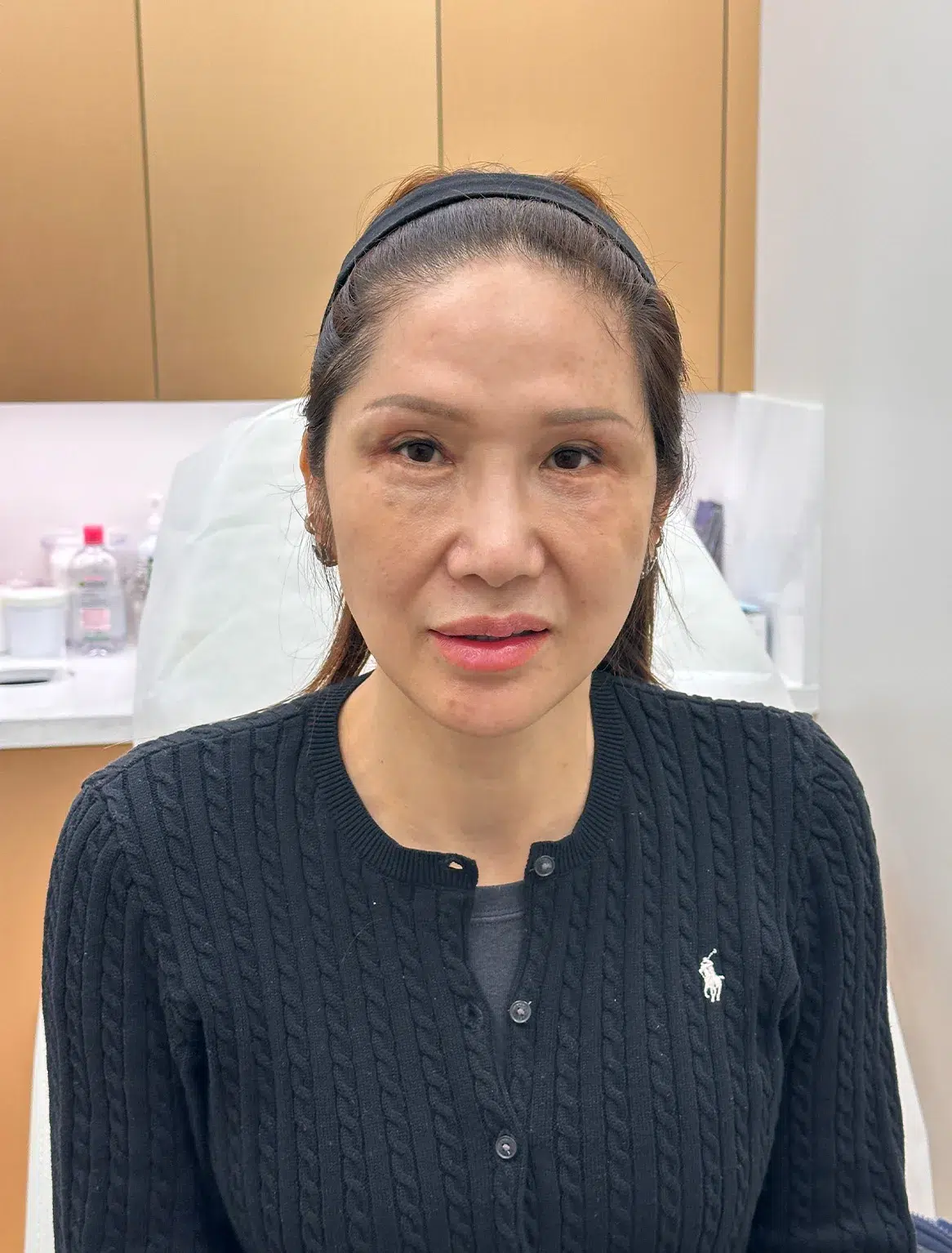 Skin Laxity, Before · Case 36 · Luowei Medical Aesthetics Clinic