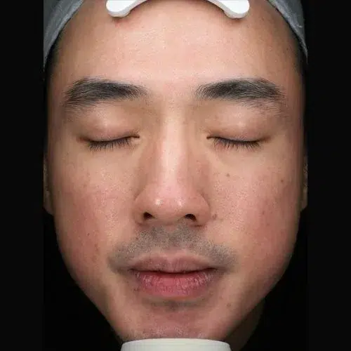 Sensitive skin after treatment · Case 01 · Luowei Medical Aesthetics Clinic