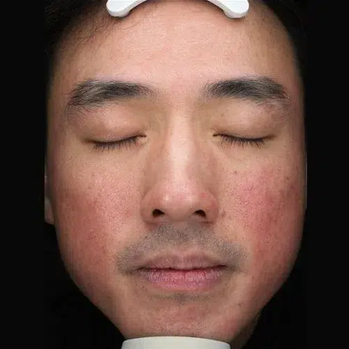 Sensitive Skin Before · Case 01 · Luowei Medical Aesthetics Clinic