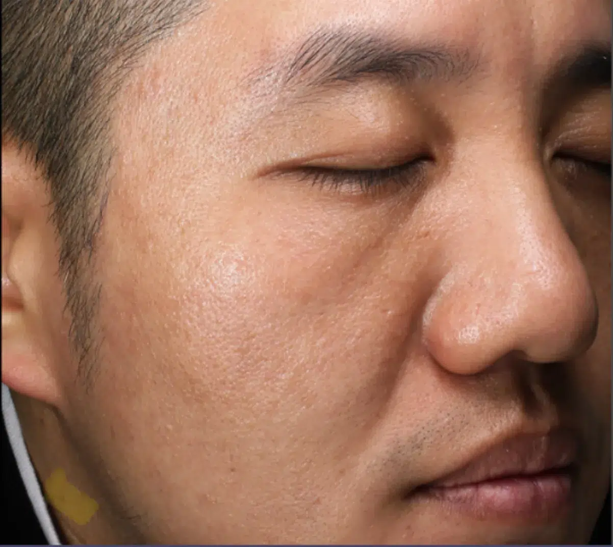 Skin Laxity After · Case 01 · Luowei Medical Aesthetics Clinic
