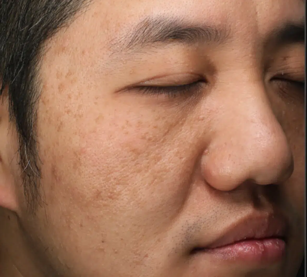 Sagging Skin · Before · Case 01 · Luowei Medical Aesthetics Clinic