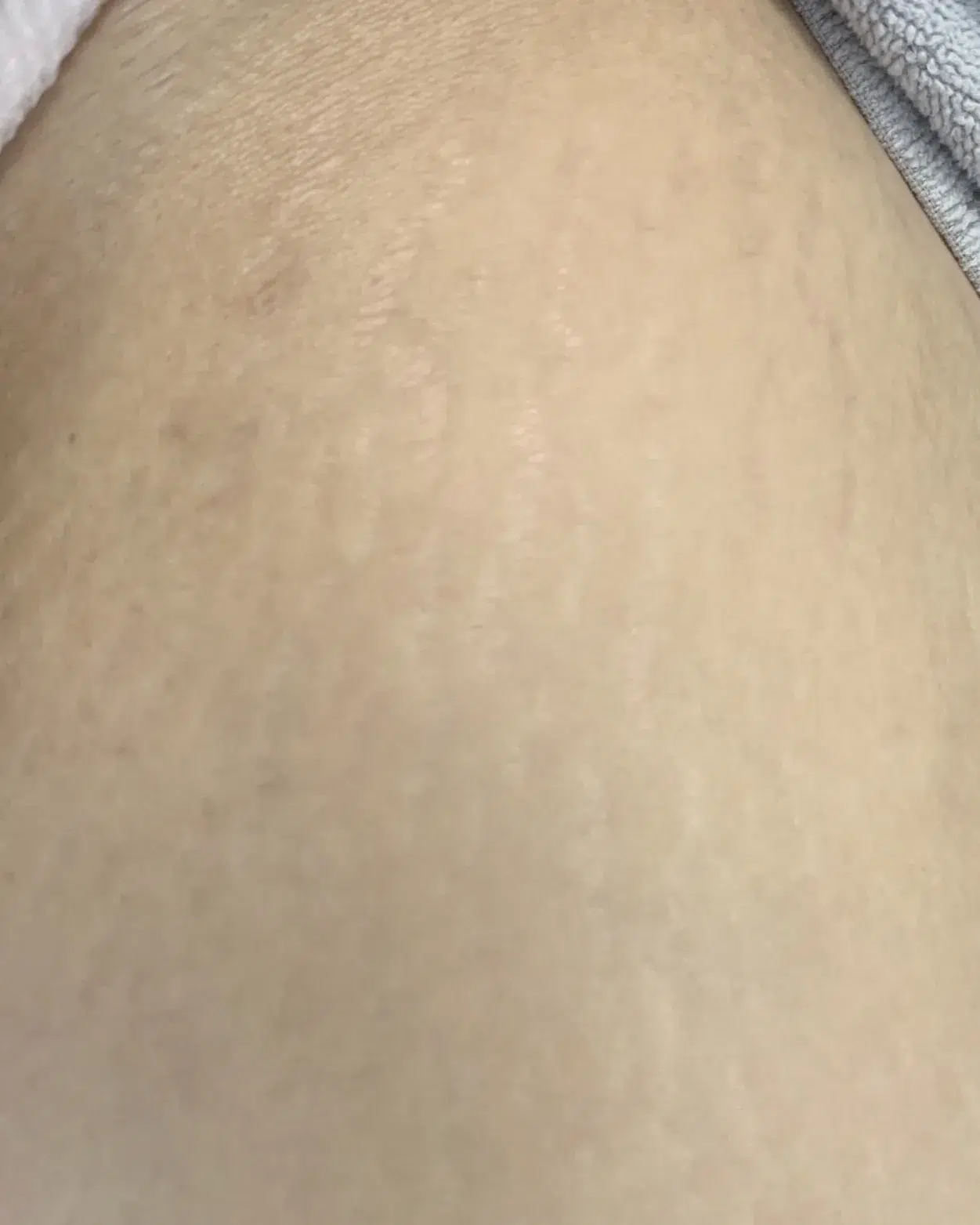 Stretch Marks / Growth Marks Post-Treatment · Case 01 · Luowei Medical Aesthetics Clinic