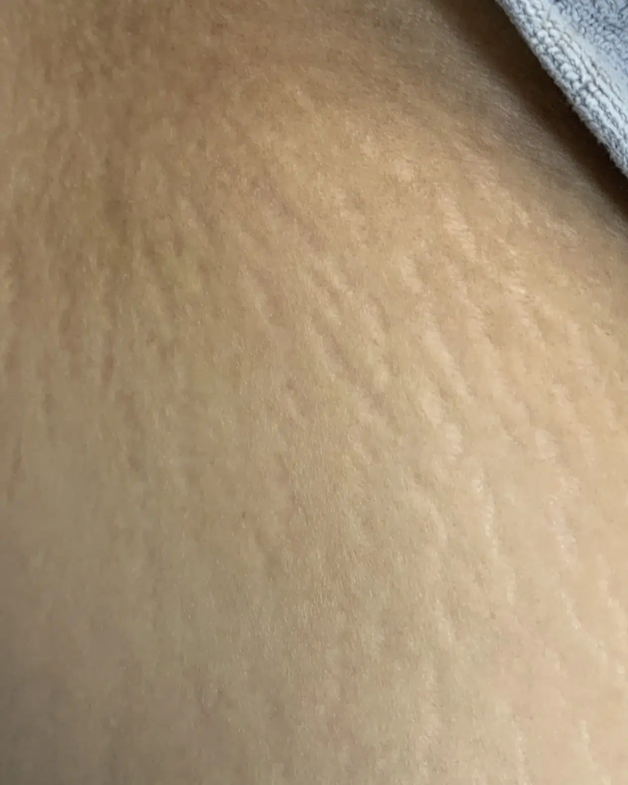 Stretch Marks / Growth Marks Before Treatment · Case 01 · Luowei Medical Aesthetics Clinic